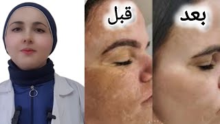 علاج الكلف في الوجه والتصبغات والبقع الداكنةب 8 أسابيع فقط melasma and hyperpigmentation treatmnt [upl. by Britta]