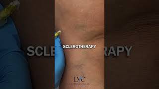 Sclerotherapy surgerysuccess medicaltiktok [upl. by Earised823]