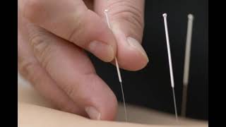 Acupuncture near me [upl. by Nicolas393]