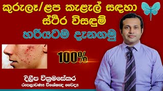 Permanently Solutions for Pimples and Scars  Sinhala [upl. by Eirdua115]