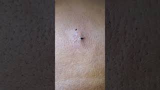 Another huge back Blackhead Squeeze [upl. by Ijan]