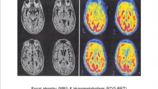 NonAlzheimers Disease Dementias [upl. by Adaiha]