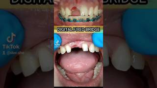 REPLACING PORCELAIN FUSED TO METAL MARYLAND BRIDGE TO DIGITAL PMMA BRIDGE dentaltips denture [upl. by Clark501]