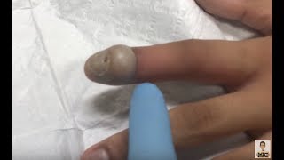 large infected bump on finger [upl. by Aerdnna]