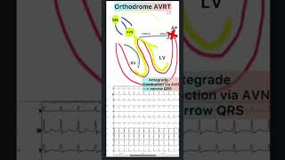 WPW phenomenon and WPW syndrome [upl. by Etta]