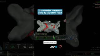 AFib Ablation Procedure Using 3D Map of Heart [upl. by Pantin282]