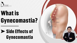 Gynecomastia Kya Hota hai  Side Effects of Gynecomastia  What is Gyno  What is Gynecomastia [upl. by Vikky]