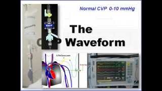 CVP and Arterial Line Waveform Interpretation [upl. by Annabel]