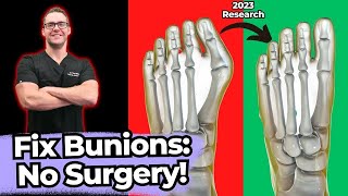 TOP 13 Ways to Shrink Bunions Naturally 1 HUGE SECRET [upl. by Chao397]