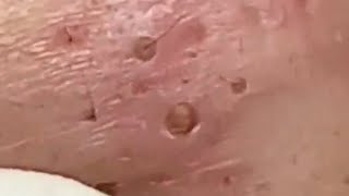 Blackheads amp Whiteheads Satisfying Removal 0105 [upl. by Aidul]