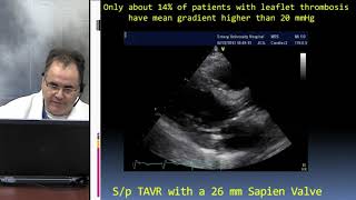 Paravalvular Leak Valve Thrombosis and More  Dr Stamatios Lerakis [upl. by Bainbrudge]