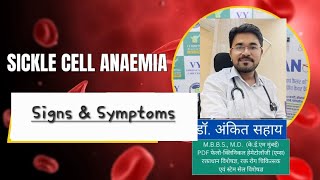 Sickle Cell Anaemia  Signs amp Symptoms  संकेत एवं लक्षण  Dr Ankit Sahay [upl. by Cornelia]