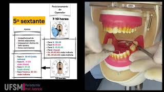 Sessão supragengival  Quinto sextante [upl. by Quartas]