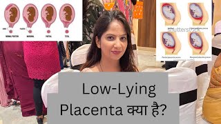 LowLying Placenta क्या है Premature Delivery से बचने के लिए इसके बारे में जानना क्यों जरूरी है [upl. by Charlene889]