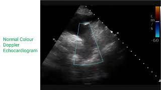 Normal Colour Doppler Echocardiogram [upl. by Hong854]