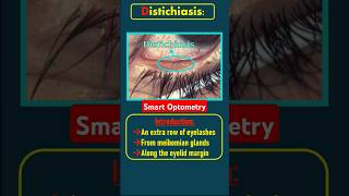 Distichiasis eyes optometry optometrist optometrists eyediseases distichiasis eyelid eyes [upl. by Ecirpac]