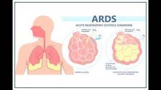 ARDS  ARDS  causes symptoms  pathophysiology  diagnosis treatment  ARDS medicine lecture [upl. by Ahsait840]