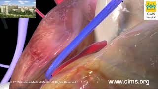 Coronary Artery Bypass Graft CABG Hindi  CIMS Hospital [upl. by Ahsenad359]