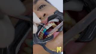 Direct veneers  BIBO BAYONA vandamcaresdentalclinic [upl. by Philips360]