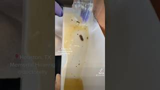 Ear irrigation  cleaning using the temperature regulated Earigator machine [upl. by Ocsecnarf224]