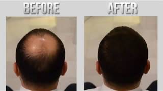 Toppik  Caboki Hair Fibers Instant Results For Baldness [upl. by Juieta]