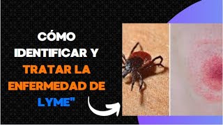 Cómo Identificar y Tratar la Enfermedad de Lymequot [upl. by Nosduh]