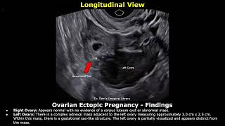 Ectopic Pregnancy Ultrasound Reporting  Tubal Interstitial Cervical Ovarian amp Heterotopic USG [upl. by Chilson]