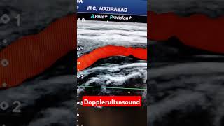 Carotid Dopplerultrasound [upl. by Leirrad]