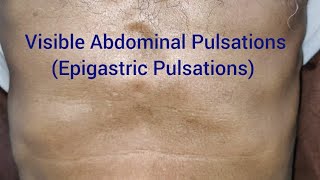 Clinical Examination Visible Epigastric Pulsations [upl. by Alisa]