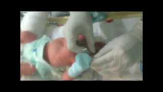 Neonatal Digital Intubation Part 1 [upl. by Eatnod961]