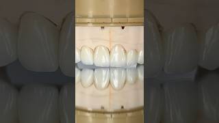 Maxillary Zen Enamel Zirconia Crowns ​⁠EnvisiontecMain envisiontec lsk121shorts dentist [upl. by Acsicnarf]