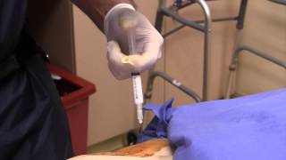 Ultrasound guided hip joint fluid aspiration and steroid injection [upl. by Ursi]