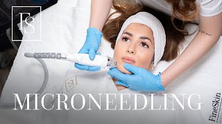 Rejuvenation RF Microneedling  Behandlungsablauf  FineSkin [upl. by Mide]