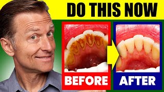 10 Tips To Reduce Swollen Gums At Home [upl. by Pownall]