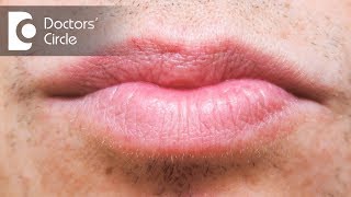 Treatment options for white spots in lips  Dr Rasya Dixit [upl. by Gaston]