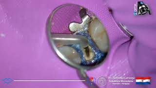 Retratamiento Endodontico en pieza 15 [upl. by Rochemont]