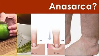 ANASARCA Clinical Treatment Approach  MEDICINE [upl. by Pax]