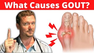 What Causes GOUT Meat Doesnt Cause Gout 2024 [upl. by Stempson]