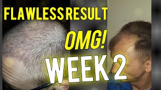 3500 grafts 2 weeks result FUE Hair Transplant [upl. by Tihom]