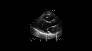 Vues Echocardiographiques Standard [upl. by Lindi]