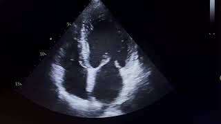 RWMADilated LA MildModerate MRMild Moderate LV Dysfunction cardio mitralregurgitation aorta [upl. by Verner]