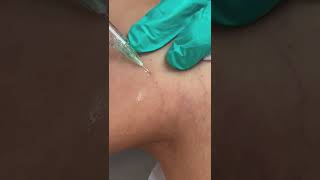 Sclerotherapy for Spider Veins [upl. by Yerxa]