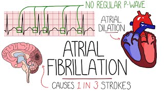 Atrial Fibrillation Made Easy Complete Overview [upl. by Vergne203]