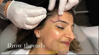 PDOTHREAD LIFT PROCEDURE BY MEDiTHREAD  Eyebrow Lift [upl. by Steve800]