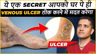 How To Treat Veins Ulcer In Leg At Home  Dr Gaurav Gangwani Interventional Radiologist [upl. by Nnaira]