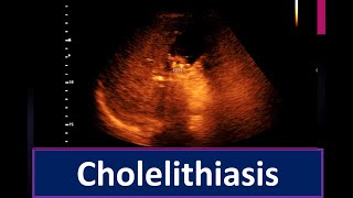 Cholelithiasis  Thickened sludge within the Gall Bladder lumen  Enlarge prostate [upl. by Annibo361]