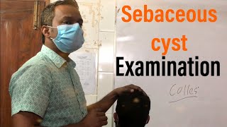 Sebaceous Cyst  examination  bangla [upl. by Eeb886]