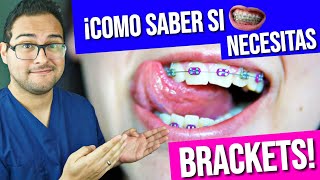 ¡COMO saber si necesito BRACKETS 👅 GUÍA PRACTICA 2019 😎 ORTODONCIA [upl. by Shaeffer879]