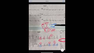 ECG 14  MAT MULTIFOCAL ATRIAL TACHYCARDIA [upl. by Assadah]