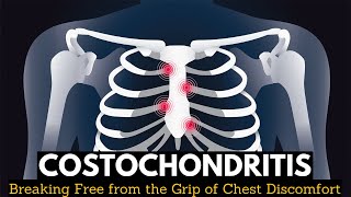 Costochondritis Breaking Free from the Grip of Chest Discomfort [upl. by Ardussi984]